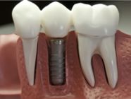 Dental Implants Canning Vale 6155, South of the River in Perth