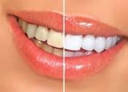 teeth whitening, teeth bleaching, before-after