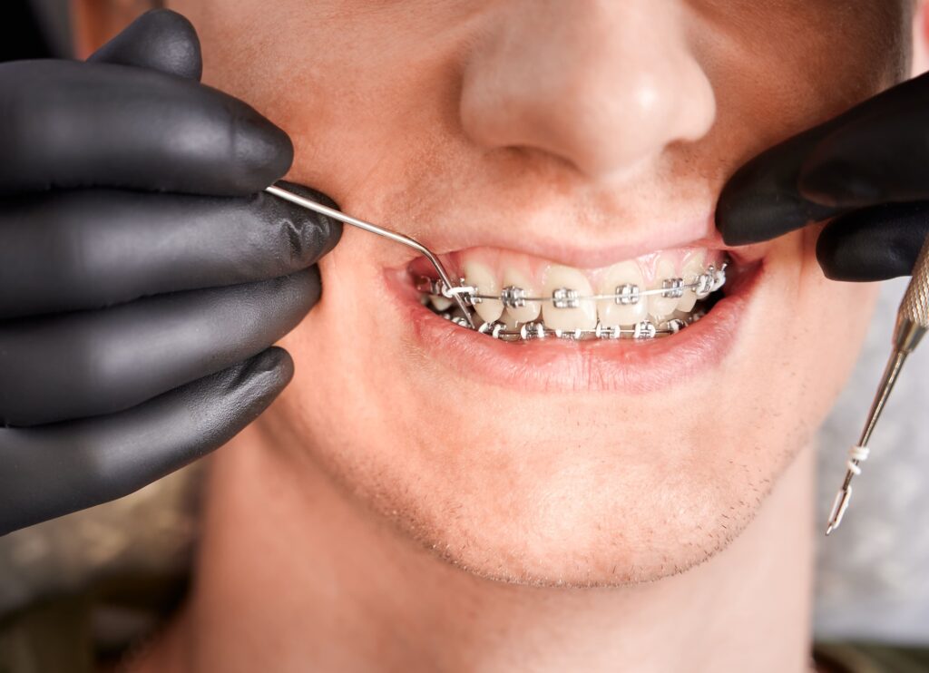Dental Braces Near Willetton | Orthodontic Assessment
