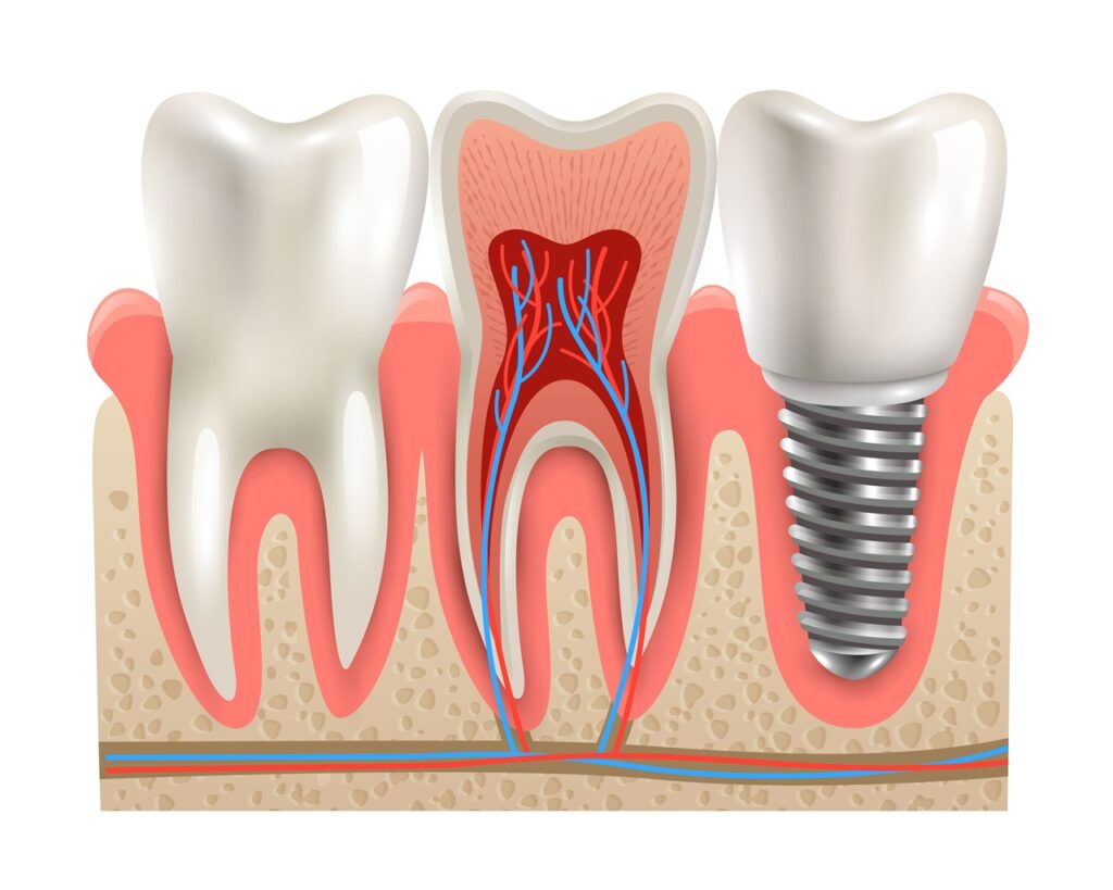 Dental Implants Canning Vale | Restorative Implant Dentistry