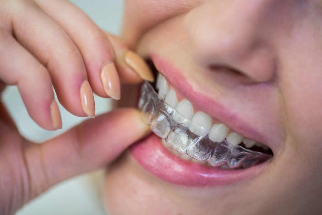 Clear Aligners & Invisalign Options Near Willetton