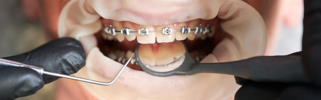 Dental Braces Near Willetton | Orthodontic Assessment