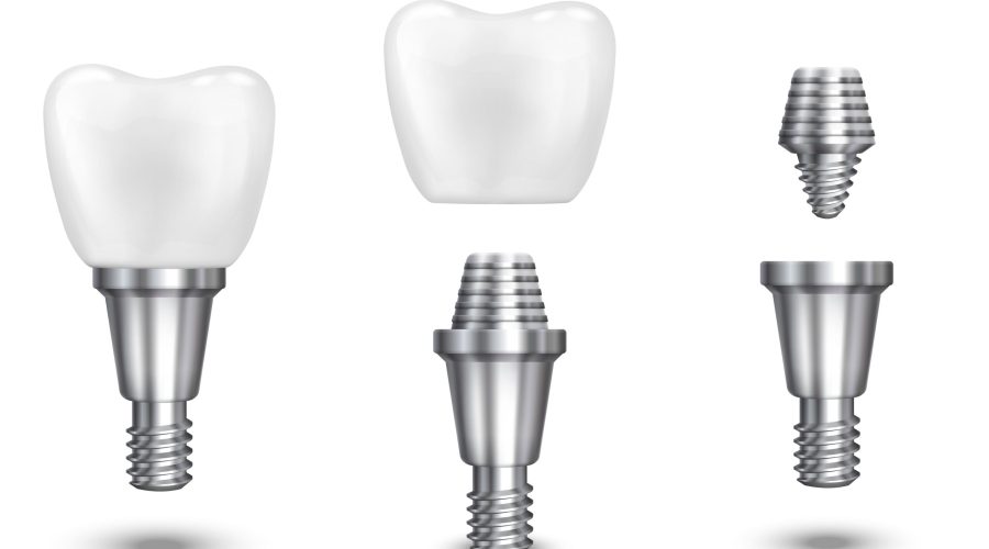 Dental Implants near Parkwood | Tooth Replacement Solutions